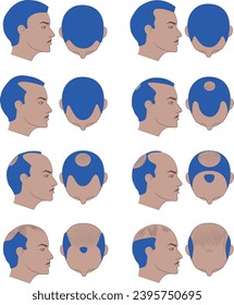 Hair loss related icons. Thin vector icon set