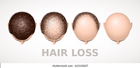 Hair loss. Set of four stages of alopecia. Eps8. RGB Global colors