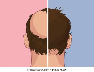 Hair loss. Stages of alopecia man problem vector medical