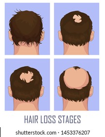 Hair loss. Stages of alopecia man problem vector medical health