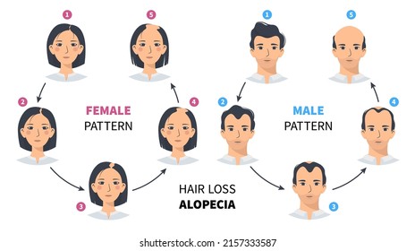 Hair loss stages, androgenetic alopecia male and female pattern. Steps of baldness vector circle infographic in a flat style with a man and a woman. Changing the hairline on the scalp