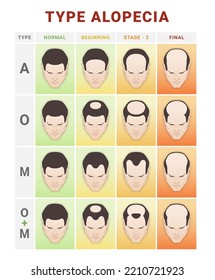 Hair loss stages infographic medical education scheme vector flat illustration. Baldness types info chart male head hairline growth steps of anatomical problem. Balding implantation medicine progress