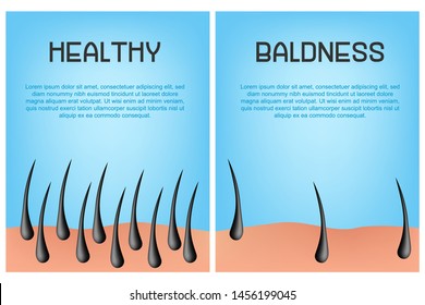 Hair loss stages set of before and after steps. Side view of a man losing hair before and after hair treatment and transplantation. number of hair on scalp before and after of treatment loss.