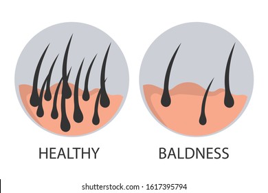 Hair loss stages set of before and after steps. Side view of a man losing hair before and after hair treatment and transplantation.