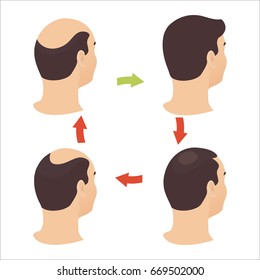 Hair loss stages set of four steps. Side view of a man losing hair before and after hair treatment and transplantation. Male alopecia pattern. Vector illustration.