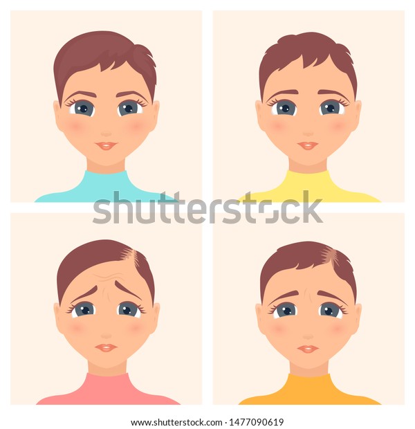 Hair Loss Stages Set Four Steps Stock Vector Royalty Free 1477090619