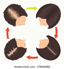 Hair loss stages set. Top view portrait of a woman before and after hair treatment and transplantation. Female pattern baldness. Isolated vector illustration.
