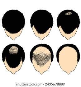 Hair loss stages vector illustration. Male pattern baldness