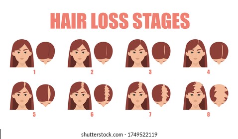 Hair loss stages vector isolated. Female alopecia. Set of balding process. Hairless woman heads front and top view.