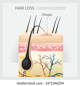 Hair Loss Structure Vector Illustration