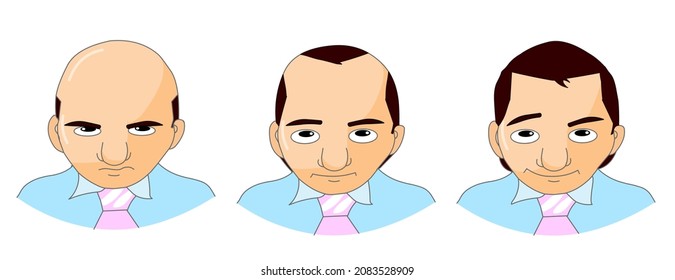 Hair loss, hair transplant. Expressions, Sad, angry, happy middle age cardboard male character. drawing from baldness to dense hairstyle. Formal, in executive attire. Illustration vector
