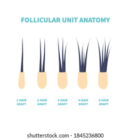 Hair micrograft classification set for hair transplantation surgery. Skin cross-section with number of hairs in the follicular unit or family. Hair science and anatomy. Cartoon vector illustration.