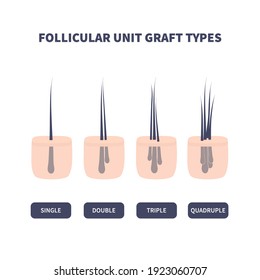 Hair micrograft classification set for hair transplantation surgery. Skin cross-section with number of hairs in the follicular unit or family. Hair science and anatomy. Cartoon vector illustration.