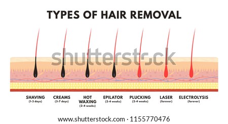 hair removal concept shaving depilation cream stock vector (royaltyhair removal concept shaving, depilation cream, waxing, epilator, plucking, laser hair removal and electrolysis comparison of different types of hair