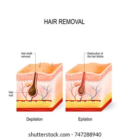 Hair removal. The difference between epilation and depilation. skincare 