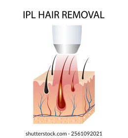 hair removal, IPL light (intense pulsed light), and laser hair removal