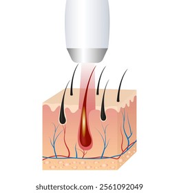 hair removal, IPL light (intense pulsed light), and laser hair removal