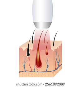 hair removal, IPL light (intense pulsed light), and laser hair removal