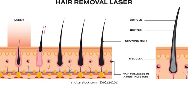 Hair Removal Laser Diagram Science Style Stock Vector (Royalty Free)  1561226152 | Shutterstock