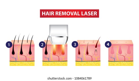 Hair Removal Laser Icon Step Vector Illustration