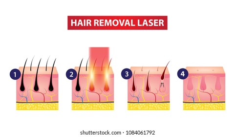 Hair Removal Laser Icon Step Vector Illustration