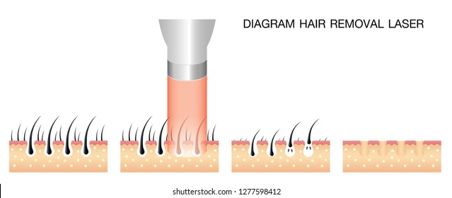 Before And After Laser Hair Removol Images Stock Photos Vectors