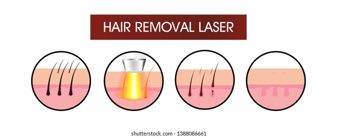Hair removal laser icon step vector illustration