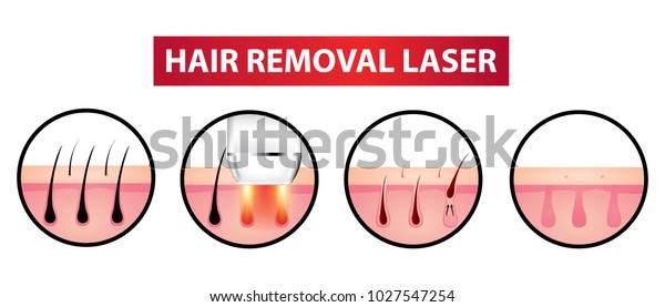 Hair removal\
laser icon step vector\
illustration