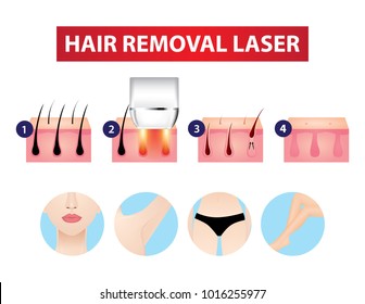 Hair removal laser step vector illustration