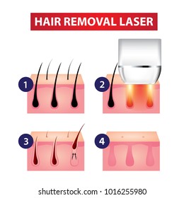 Hair removal laser step vector illustration