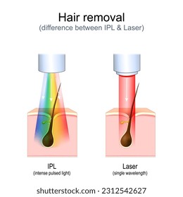 depilación. Láser vs luz pulsada intensa (IPL). Diagrama de vectores sobre la piel y el pelo durante la sesión de tratamiento. Cirugía estética. anuncios de belleza. Ilustración realista