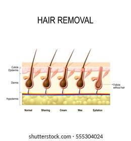 Hair removal with wax, cream, epilation and shaving. The height of the removal of the hair shaft. different methods. 