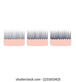 Hair thickness types classification set. Skin cross-section with fine, normal, thick strands in diameter. Anatomical structure linear scheme. Outline vector illustration.