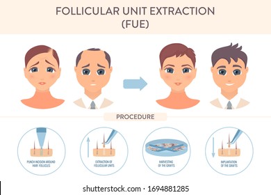 Hair transplant alopecia treatment by FUE. Stages of follicular unit extraction restoration surgery for women and men. Health care and medical concept. Vector illustration.