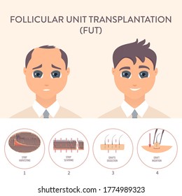 Hair transplant alopecia treatment by FUT. Stages of follicular unit transplantation restoration surgery for men. Health care and medical concept. Vector illustration.