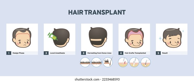 Hair Transplant for Men, Male Hair Transplant, A Bald Man Gets A Hair Transplant