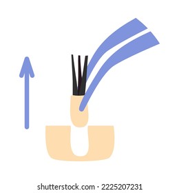 Hair transplant treatment forceps symbol. Surgical tweezers pulling out hair follicle. Alopecia medical procedure equipment tool. Hair loss diagnosis and transplantation concept. Vector illustration.