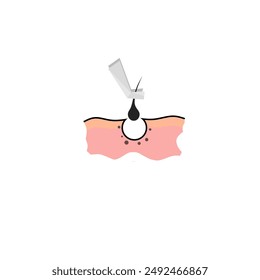 Hair transplant treatment symbol. Baldness diagnosis and hair transplantation concept icon. Alopecia medical treatment procedure. Vector illustration for clinics and diagnostic centers