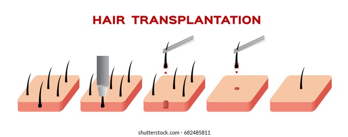 hair transplant vector