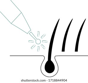 Hair Transplant Vector. Hair follicle treatment. 