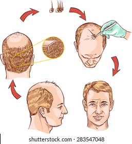 hair transplantation