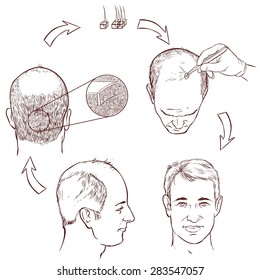 hair transplantation