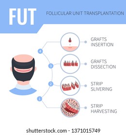 Hair transplantation alopecia treatment by FUT in men. 4 steps infographics. Stages of follicular unit transplantation restoration surgery for male patients. Vector template for clinics.