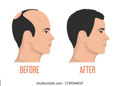 Hair transplantation before and after vector isolated. Alopecia treatment, forget about baldness. Hairless man.