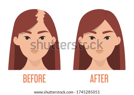 Hair transplantation before and after vector isolated. Alopecia treatment, forget about baldness. Hairless woman.