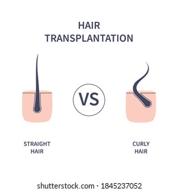 Hair transplantation for different hair types. Skin cross-section with straight and curly strands. Human hair growth style chart. Health care and beauty concept. Vector illustration.