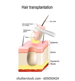 hair transplantation. Follicular unit. hair loss treatment. Alopecia.