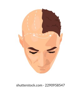 Hair transplantation illustration in color cartoon style. Editable vector graphic design.