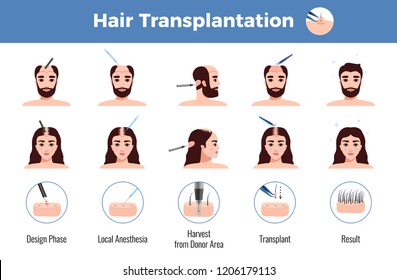 Hair transplantation for men and women with stages of operation infographics on white background vector illustration