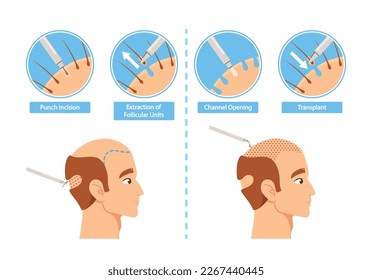 Hair Transplantation Procedure Infographics. Punch Incision, Extraction of Follicular Units, Channel Opening and Transplant Stages For Medical Or Health-related Content. Cartoon Vector Illustration